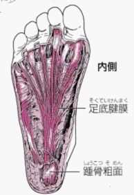 足底腱膜炎