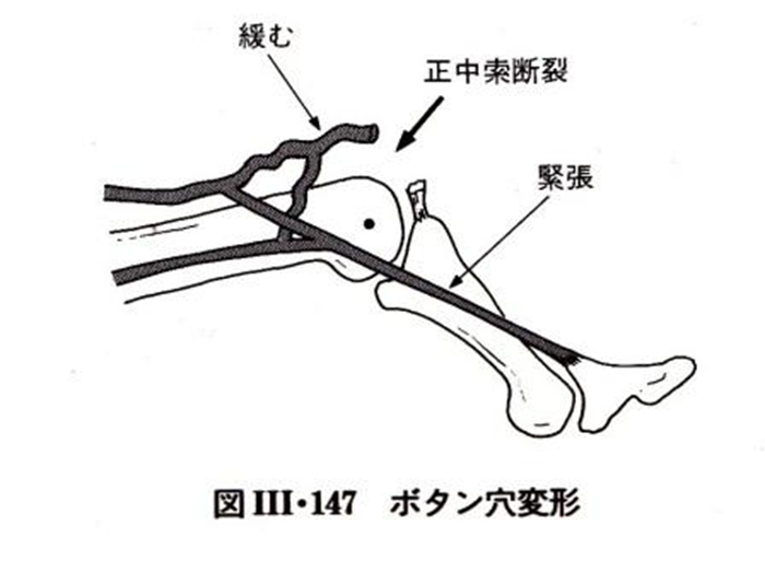 されど突き指