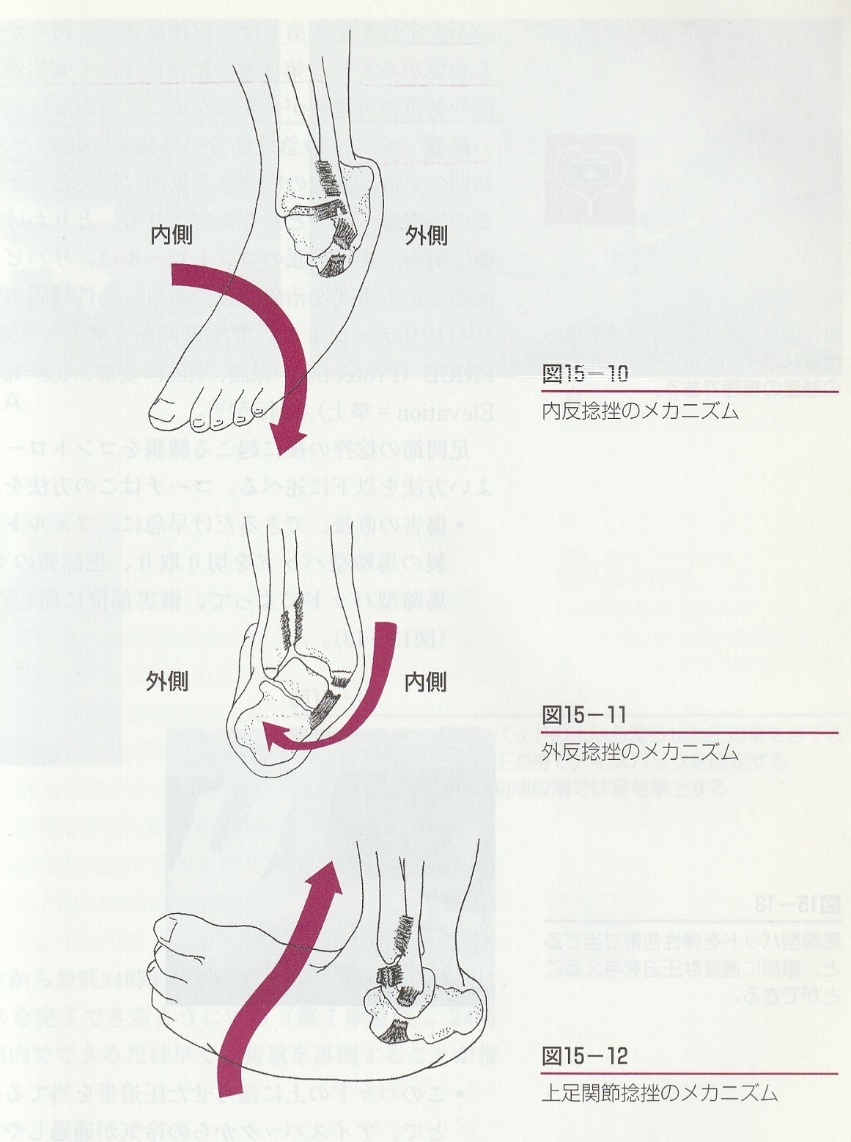 足関節捻挫