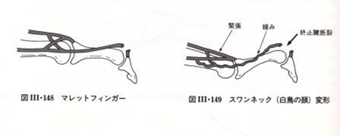 悪い突き指